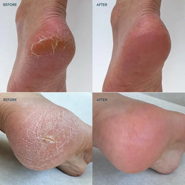 Heel Repair Duo